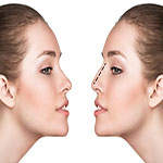 زیبایی بینی بدون جراحی