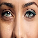 بهترین روش رفع گودی و کبودی زیر چشم