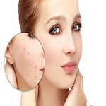 ویدئو خارج کردن جوش های زیرپوستی
