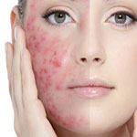ویدئو ساب سیژن جهت رفع جوش های عمقی