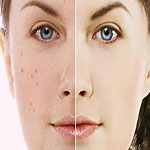 چگونه جای جوش ها را از بین ببریم ؟