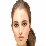 ترانکسامیک اسید رفع تیرگی و لک