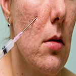 ( subcision ) ساب سيژن