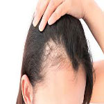 زنان مبتلا به ريزش موى آندروژنيک