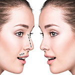 زیبایی بینی بدون عمل با نخ و فیلر