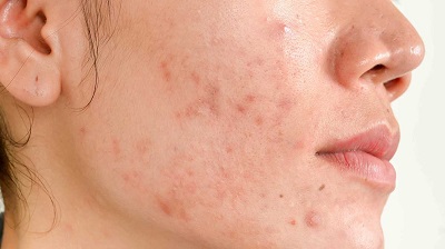 اسکار جای جوش صورت و روشهای درمان آن