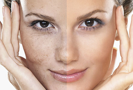 علل تیرگی پوست (هایپرپیگمنتاسیون) و روش های درمان آن