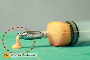 آیا تکنیک تزریق چربی در ماندگاری آن موثر است