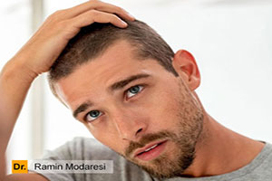 مهمترین علل ریزش مو در مردان و درمان آن