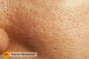 روشهای درمان منافذ باز پوست