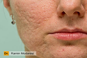 میکرونیدل آر اف چیست و چه تأثیری روی پوست دارد؟
