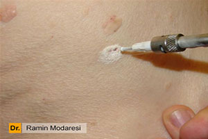 کاربردهای کرایوتراپی در درمان بیماری های پوستی