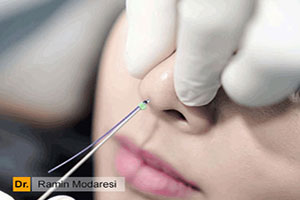 اصلاح فرم بینی بدون جراحی، به روش لیفت بینی با نخ