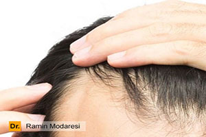 درباره کاشت مو به روش FIT بیشتر بدانید