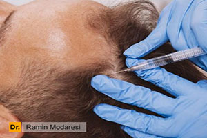 تقویت فولیکولهای مو با مزوتراپی، پی آر پی و هیر فیلر