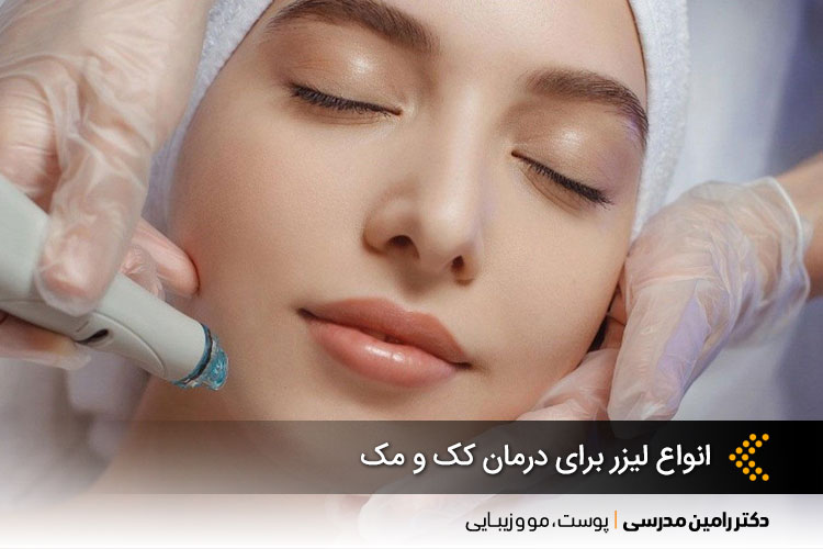 انواع لیزر برای درمان کک و مک