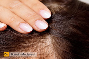 قرص فیناستراید برای درمان ریزش مو مؤثر است؟