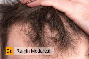 روشهای غیر جراحی تقویت و ضد ریزش مو