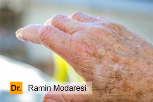 لکه های قهوه ای روی پوست دست نشانه چیست؟