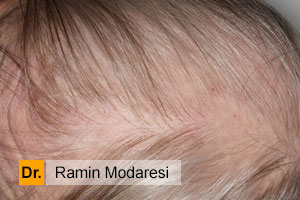 آیا چربی پوست سر موجب ریزش مو می شود؟