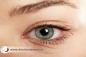 تزریق بوتاکس به خطوط پنجه کلاغی اطراف چشم