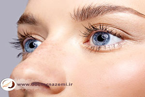 انواع روشهای جوانسازی زیر چشم