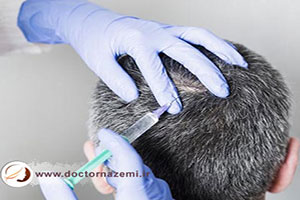 آیا مزوتراپی در درمان ریزش مو موثر است؟