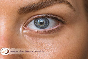 چگونه ورم بعد از تزریق ژل را از بین ببریم