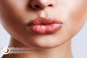 تغییرات پس از تزریق یک سی سی ژل لب