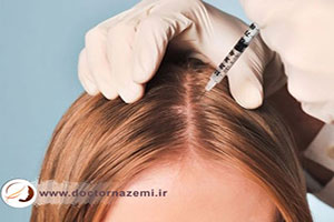 درمان ریزش مو سکه ای با تزریق کورتون رقیق شده