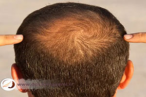 مصرف سیکلوسپورین برای درمان ریزش موی ارثی