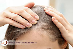 فیناستراید (پروپشیا) درمانی دارویی برای مشکل ریزش مو