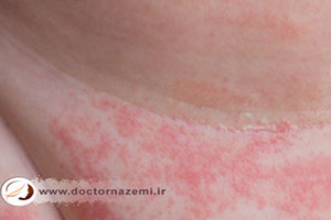 پیشگیری و درمان راش پوستی ناحیه تناسلی