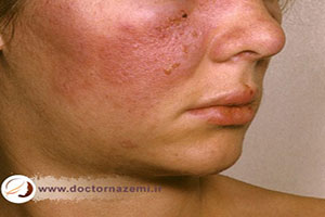 بیماری لوپوس چیست و چه علائمی دارد؟