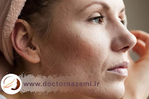 پوست صورت پس از سابسیژن به چه مراقبتهایی نیاز دارد؟
