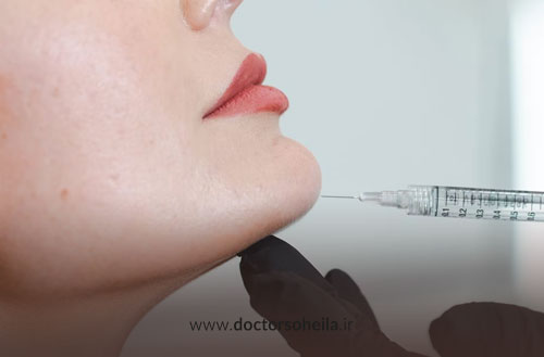 تزریق ژل چانه؛ روش انجام، مراقبت ها، ماندگاری و هزینه