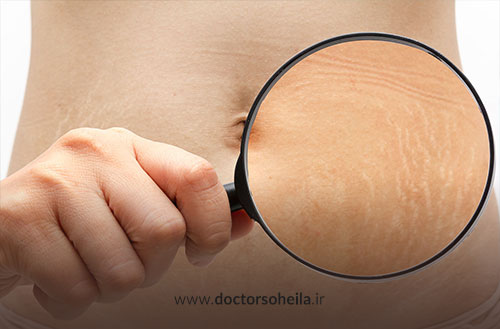 استرچ مارک یا ترک پوستی؛ تشخیص، پیشگیری و درمان