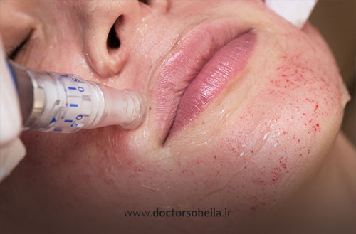 همه چیز درباره میکرونیدلینگ در اصفهان