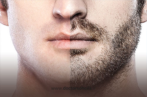 کاشت ریش و سبیل؛ روشها، نحوه انجام و هزینه کاشت ریش 1404