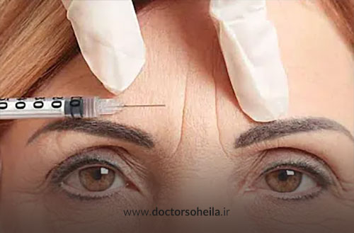 بوتاکس خط اخم؛ رفع خط اخم عمیق با تزریق بوتاکس
