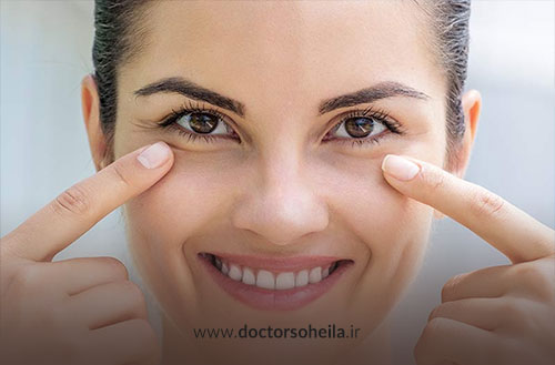 بوتاکس زیر چشم در اصفهان؛ رفع چروک و گودی زیر چشم با بوتاکس