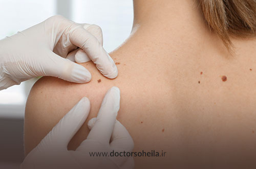 خالبرداری با RF؛ بهترین روش برداشتن خال با آر اف سرجیکال 2025