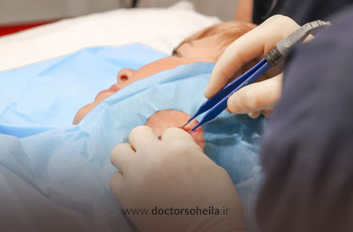 برداشتن خال با جراحی؛ عوارض و مراقبت بعد از عمل + هزینه جراحی خال 1404