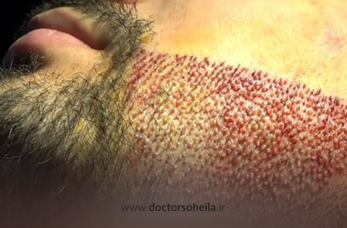 عوارض کاشت ریش و سبیل؛ آیا کاشت ریش عوارض دارد؟