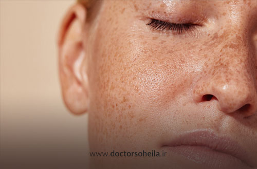 برداشتن کک و مک با پلاسما جت؛ روش موثر درمان کک و مک با پلاسما