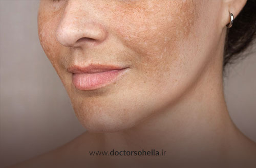 لیزر کک و مک؛ برداشتن کک و مک با لیزر + قیمت لیزر کک و مک صورت