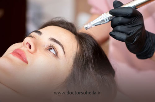 میکرونیدلینگ برای مو؛ بررسی دستگاه میکرونیدلینگ + هزینه میکرونیدلینگ مو