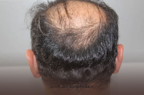 بانک مو چیست و راهکارهای تقویت و کاشت با بانک موی ضعیف