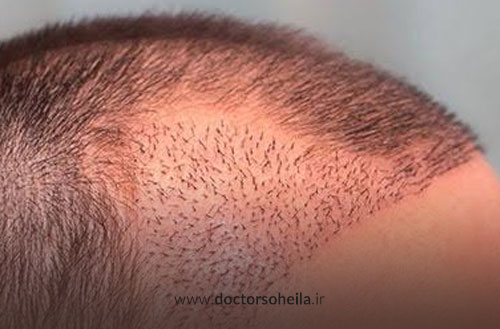راهنمای جامع مراقبت های بعد از کاشت مو؛ گام به گام تا نتیجه ایده آل