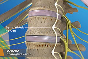 درمان دردهای ناشی از دیسک با بلوک سمپاتیک کمری